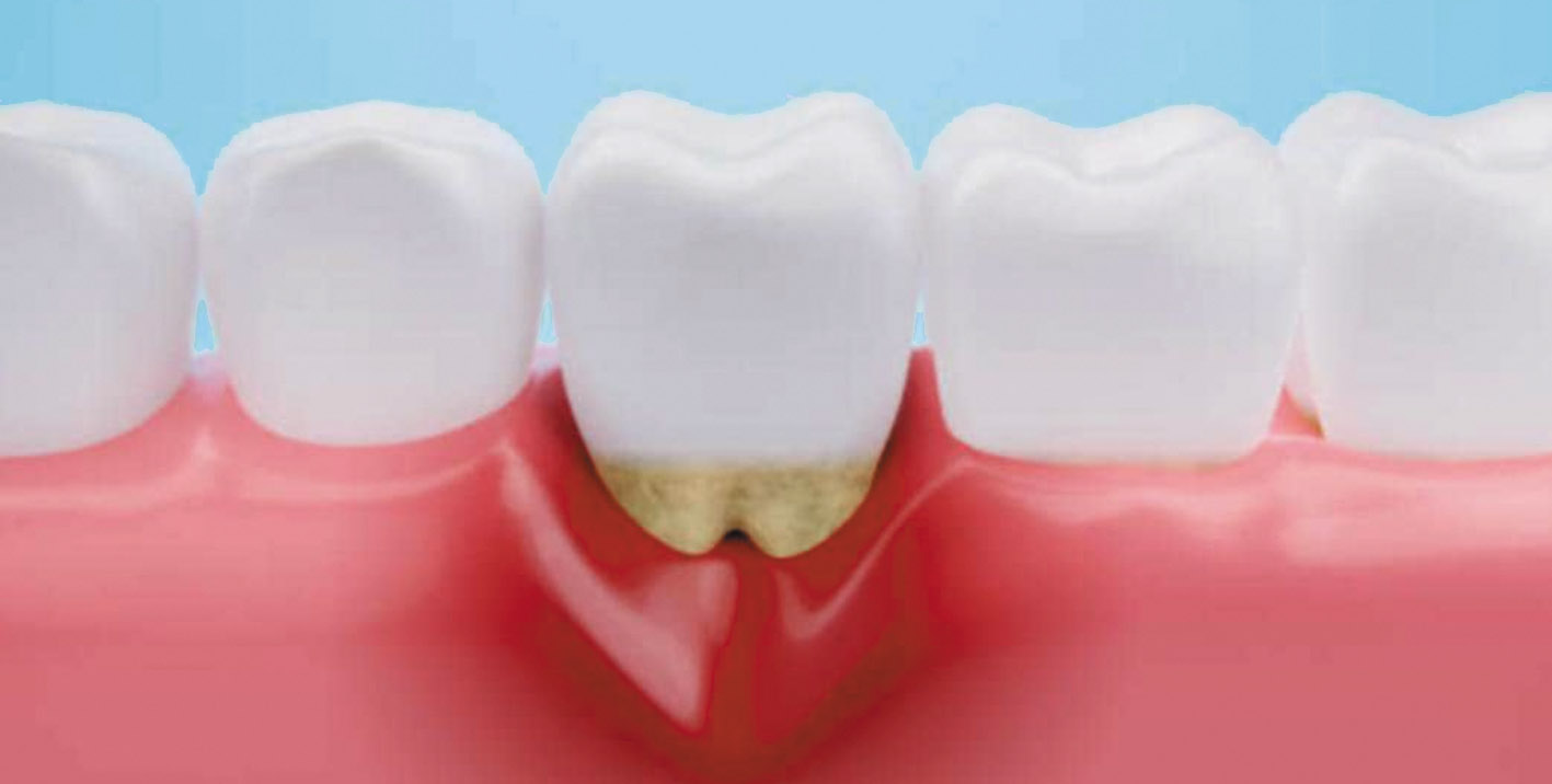 ¿Qué es? y ¿Cómo prevenir la enfermedad periodontal? 